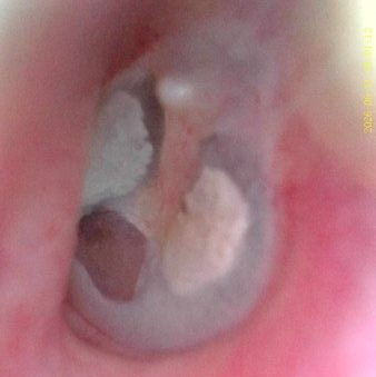 Ear Wax Removal using microsuction in Weymouth showing a perforated eardrum
